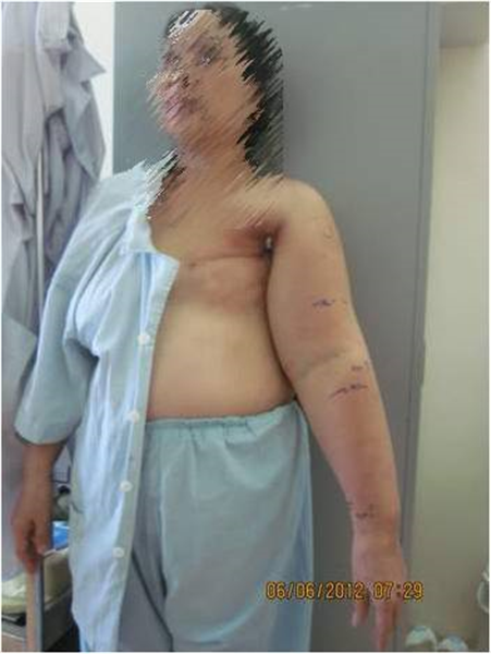 Điều trị phù tay voi, chân voi